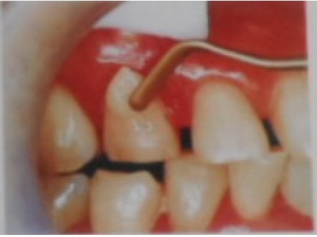 充填光固化复合树脂